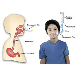 RYLES FEEDING TUBE